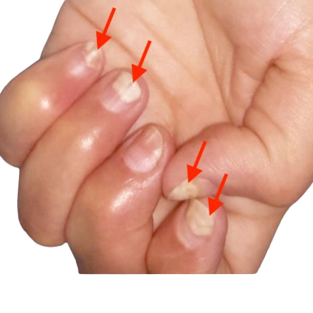 Nagelpilz-Finger-Nagelpilz-am-daumen-jenn_cosmetic