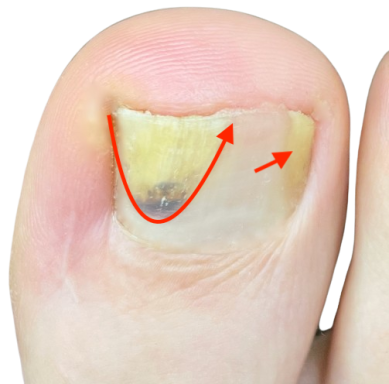 nagel_löst_sich_vom_nagelbett_nach_verletzung_was_tun