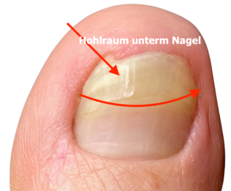 hohlraum_unterm_nagel_ursache_jenn_cosmetic