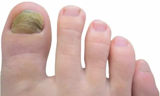 Holznagel Zeh mit stark verdicktem und verhärtetem Zehennagel