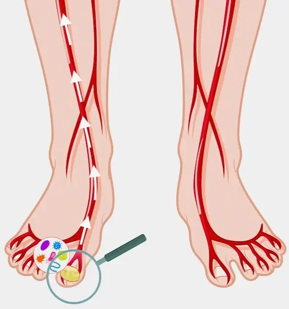 sieht aus wie nagelpilz ist aber keiner