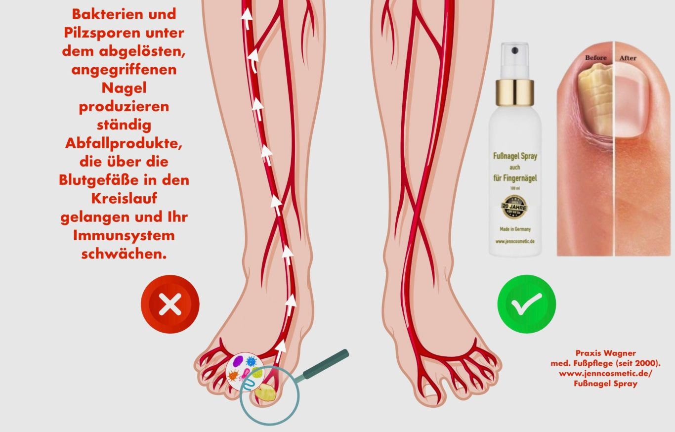 holznagel-am-zeh-jenncosmetic-fussnagel-spray