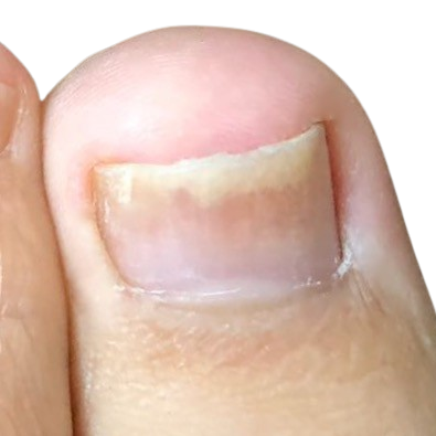 nagel-loest-sich-vom-nagelbett-nach-verletzung-praxis-wagner-fusspflege-deisenhofen