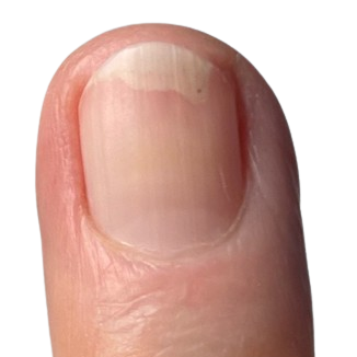 Nagelpilz-Finger-Nagelpilz-am-daumen-fussnagel-spray