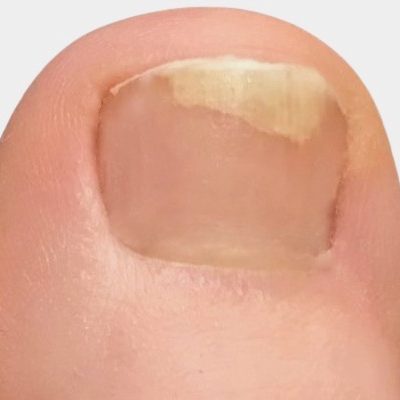 nagel-loest-sich-vom-nagelbett-nach-verletzung-praxis-wagner-fusspflege-deisenhofen