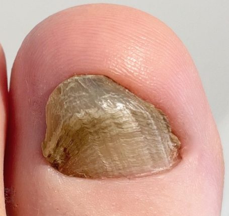 zehennaegel krankheiten-jenncosmetic