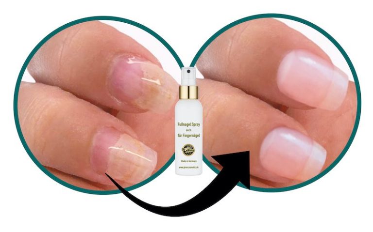 nagelpilz-finger-jenncosmetic