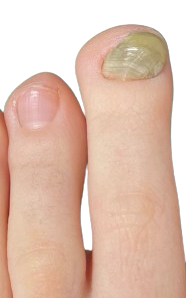 nagel-loest-sich-vom-nagelbett-ab