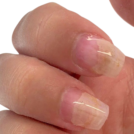 Nagelpilz-Finger-Nagelpilz-am-daumen