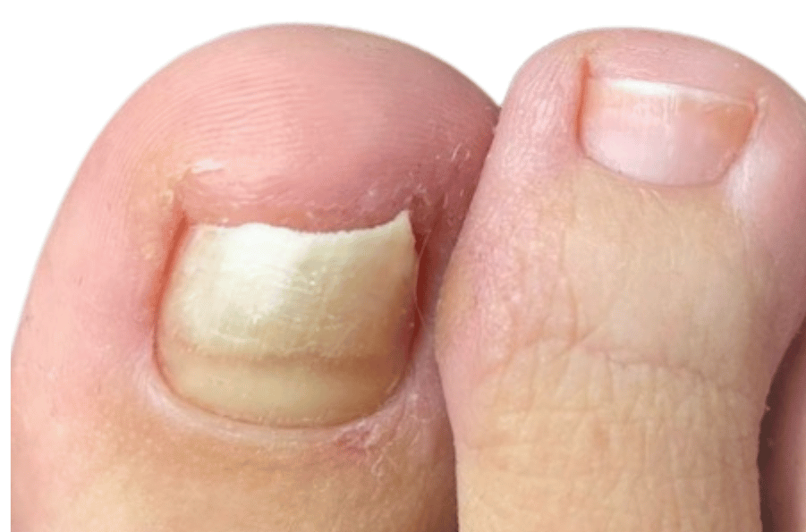 weiße Flecken im Nagel, Hohlraum unterm Nagel was tun