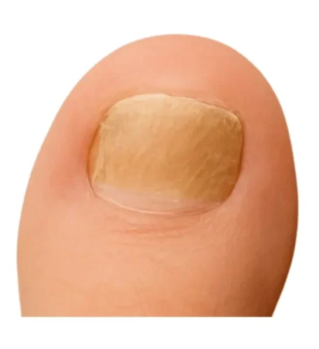 Wie sieht Nagelpilz aus? 