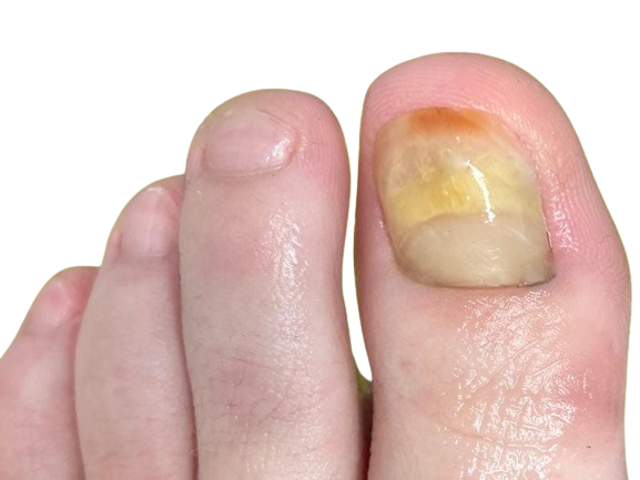 Nagelpsoriasis