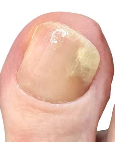 nagel_löst_sich_vom_nagelbett_nach_verletzung_was_tun_jenn_cosmetic