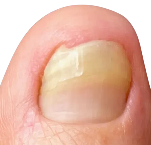 Nagelpsoriasis-jenncosmetic