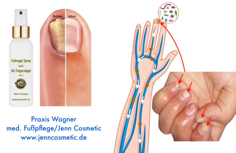nagelpilz-finger-nagelpilz-am-daumen-nagelpilz-am finger-nagelpilz-daumen