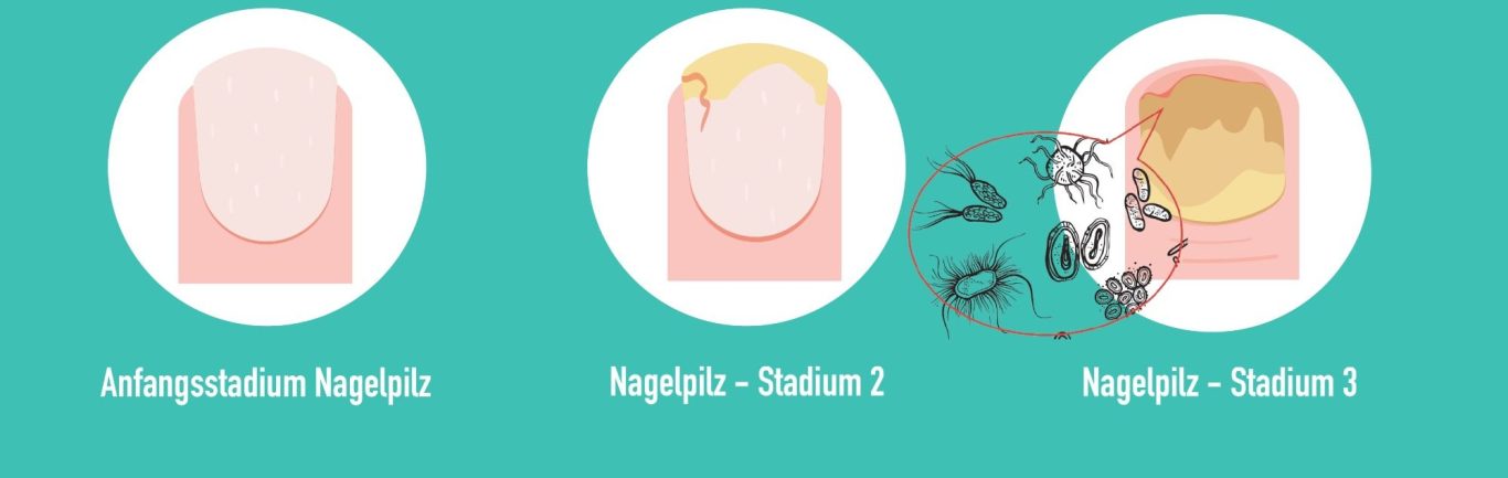 anfangsstadium-nagelpilz-fussnagelpilz-fußnagelpilz-jenncosmetic