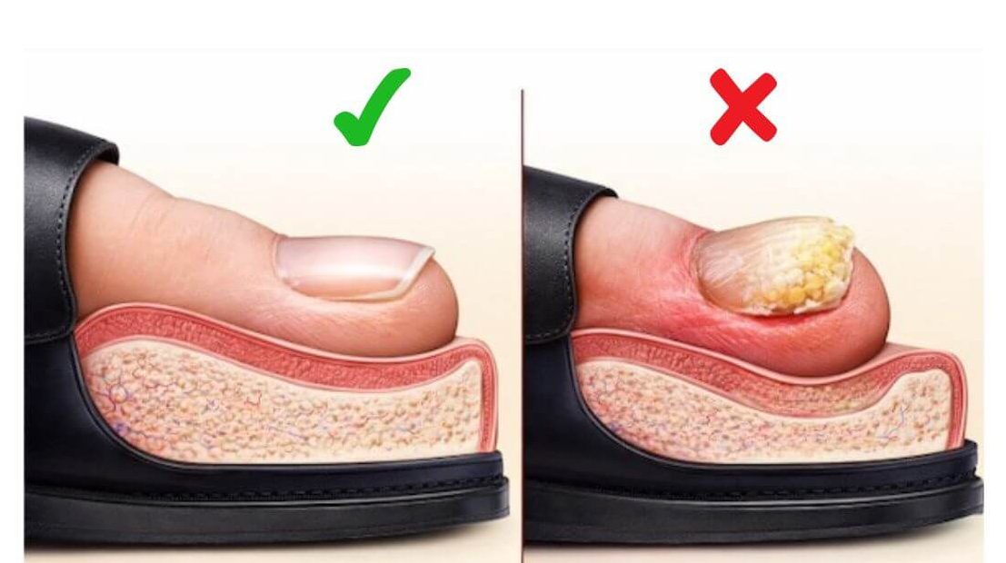 verdickte Zehennägel, kein Pilz. Was tun?
