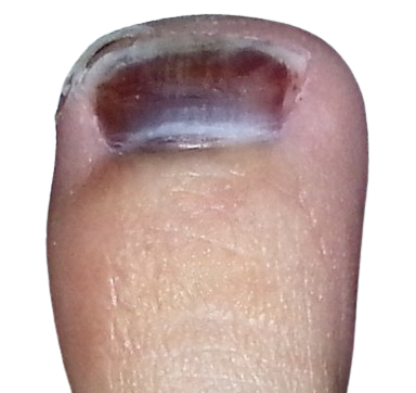 zehennaegel krankheiten-jenncosmetic