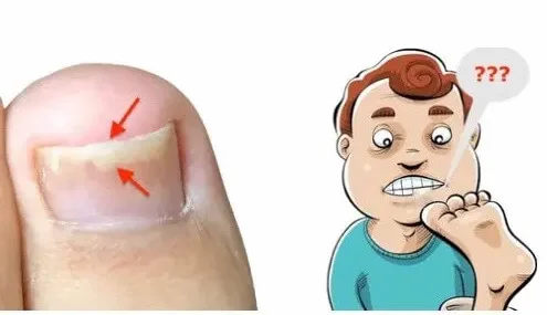 gelbe fussnägel kein pilz jenncosmetic